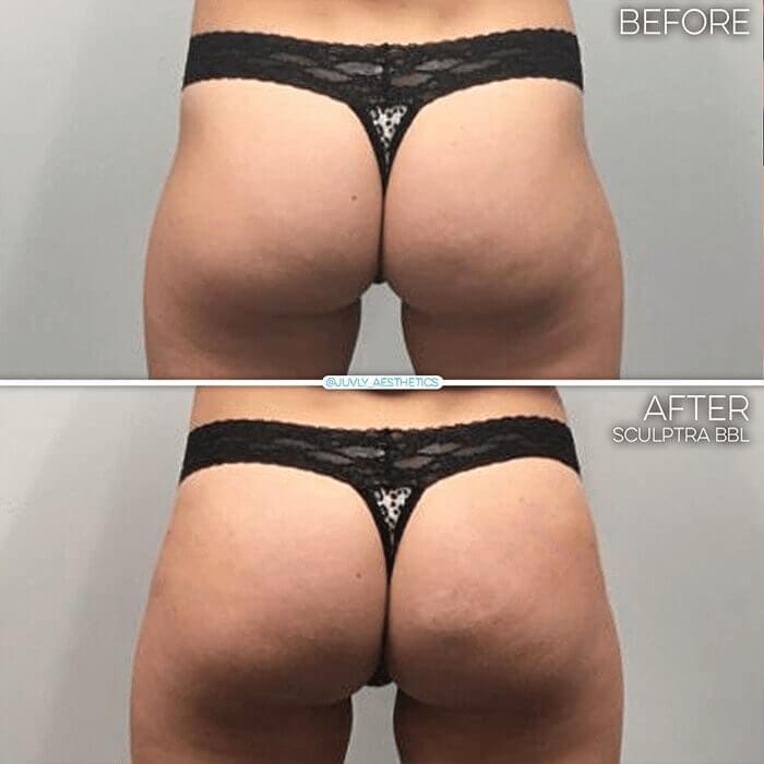 before and after at med spa