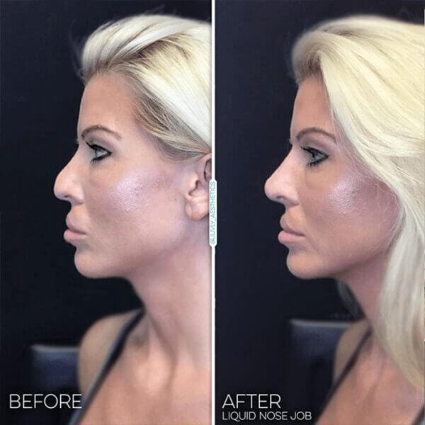 Juvly Aesthetics Painless NonSurgical Liquid Nose Job