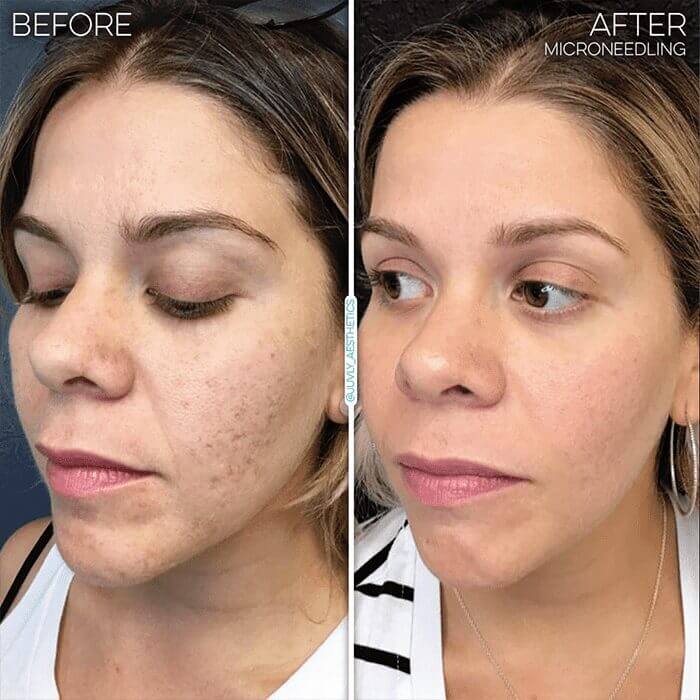 skin-resurfacing-microneedling