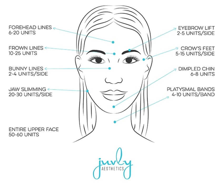 Dysport Face Chart