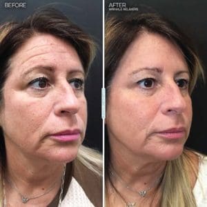 Botox-units-results-woman
