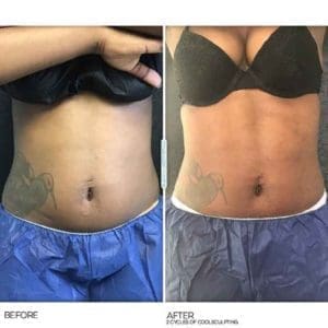 Coolsculpting-diet-exercise-fat-results-woman-min