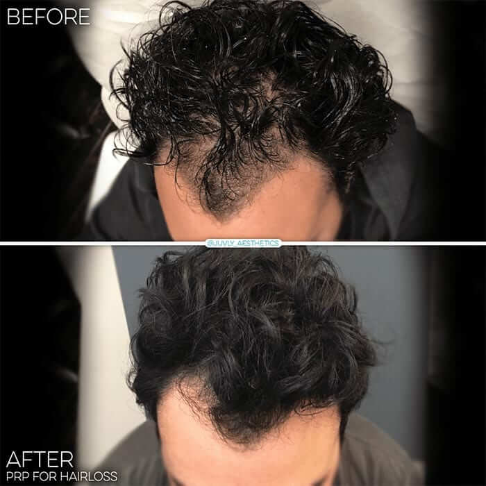 before-after-prp-hairloss-results