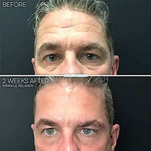 botox-vs-dysport-difference-results-man