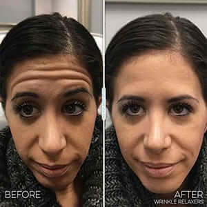 botox-vs-dysport-difference-results-woman botox-vs-dysport-difference-results-woman