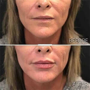 first-time-lip-filler-lip-injectionsexpectations-results-lady first-time-lip-filler-lip-injectionsexpectations-results-lady