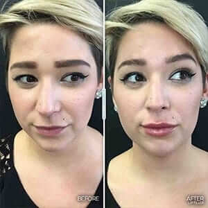 first-time-lip-filler-lip-injectionsexpectations-results-woman first-time-lip-filler-lip-injectionsexpectations-results-woman