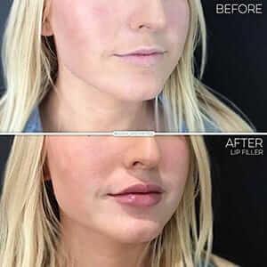 lip-filler-your-way-results-girl