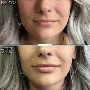 lip-filler-your-way-results-lady lip-filler-your-way-results-lady