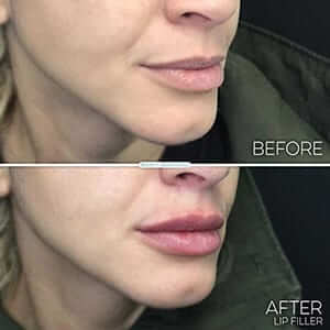 lip-filler-your-way-results-woman lip-filler-your-way-results-woman