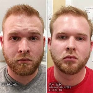 top-9-benefits-botox-dysport-results-man-min