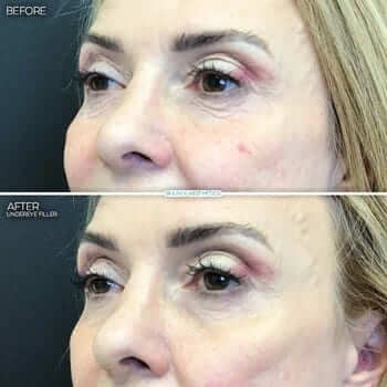 before-after-undereye-fillers
