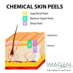 chemical-peels-penetration chemical-peels-penetration
