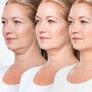 coolsculpting-double-chin-fat