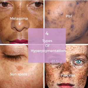 four-types-of-hyperpigmentation