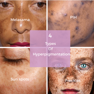 The Best Hyperpigmentation Treatment Revealed – Gleamin