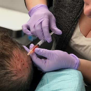 prp-for-hair-injections
