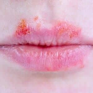 lip-allergies