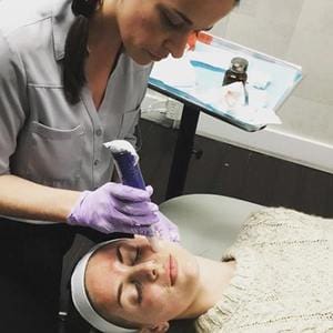 microneedling-my-review