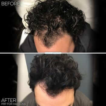 prp-for-hair-works-results-man prp-for-hair-results-man