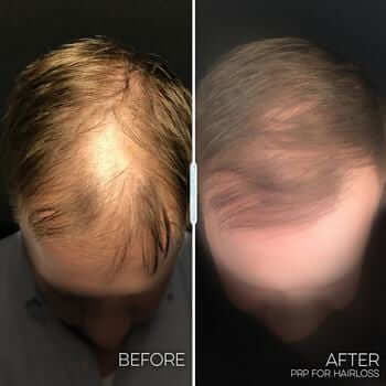 PRP To Improve Hair Growth – Juvly Aesthetics