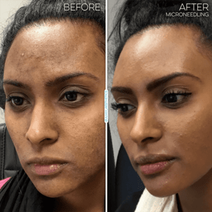 How to treat hyperpigmentation from laser hair removal