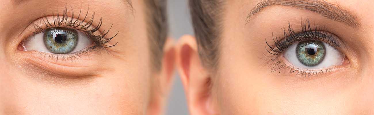 types-of-undereye-conditions-featured-min