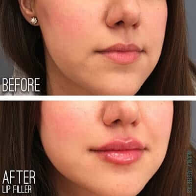 before-after-ultra-plus-filler