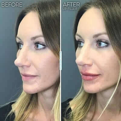 lip-injections-before-after