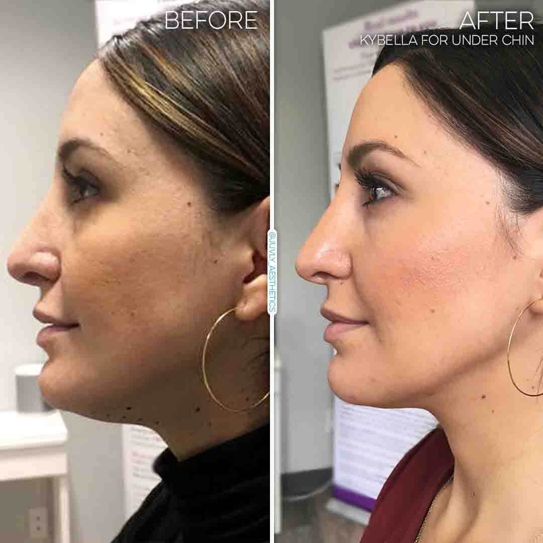 how-does-kybella-work-results-lady-min