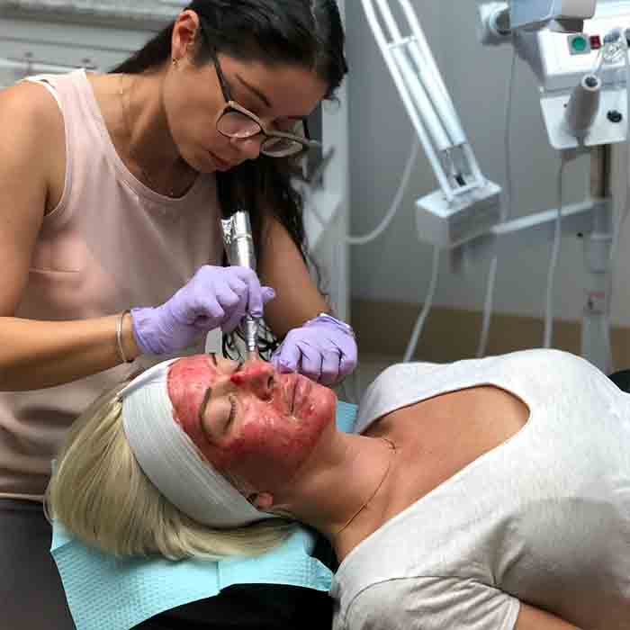 popular-microneedling-myths-busted-face (1)