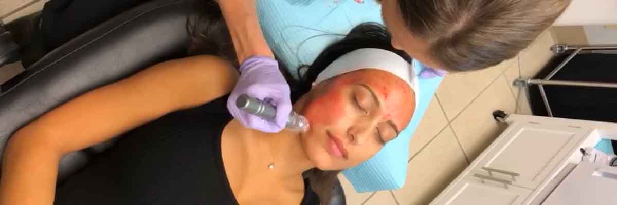 popular-microneedling-myths-busted-featured (1)