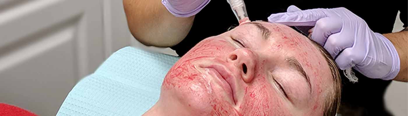 what-is-microneedling-top-5-benefits-featured