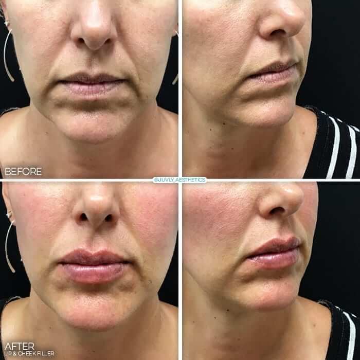 juvly gallery cheek filler results
