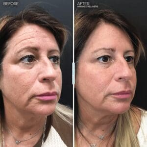 juvly image gallery botox forehead