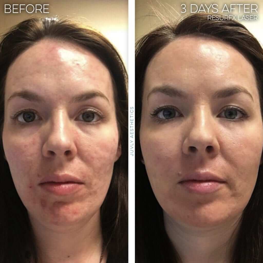 juvly image gallery laser skin resurfacing resurfx skin