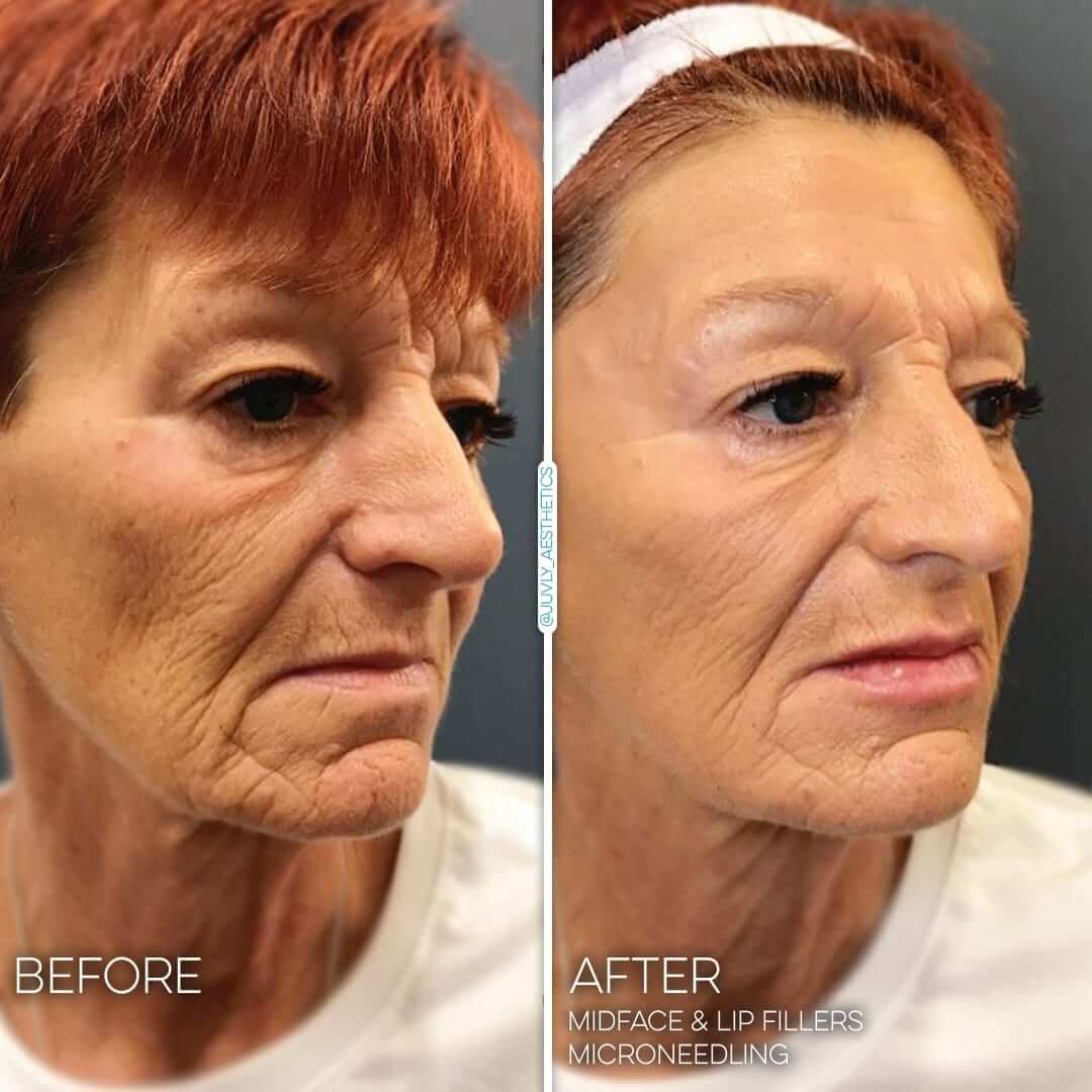 juvly image gallery microneedling skincare