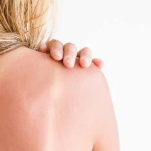 sunburn stages and prevention sun damage
