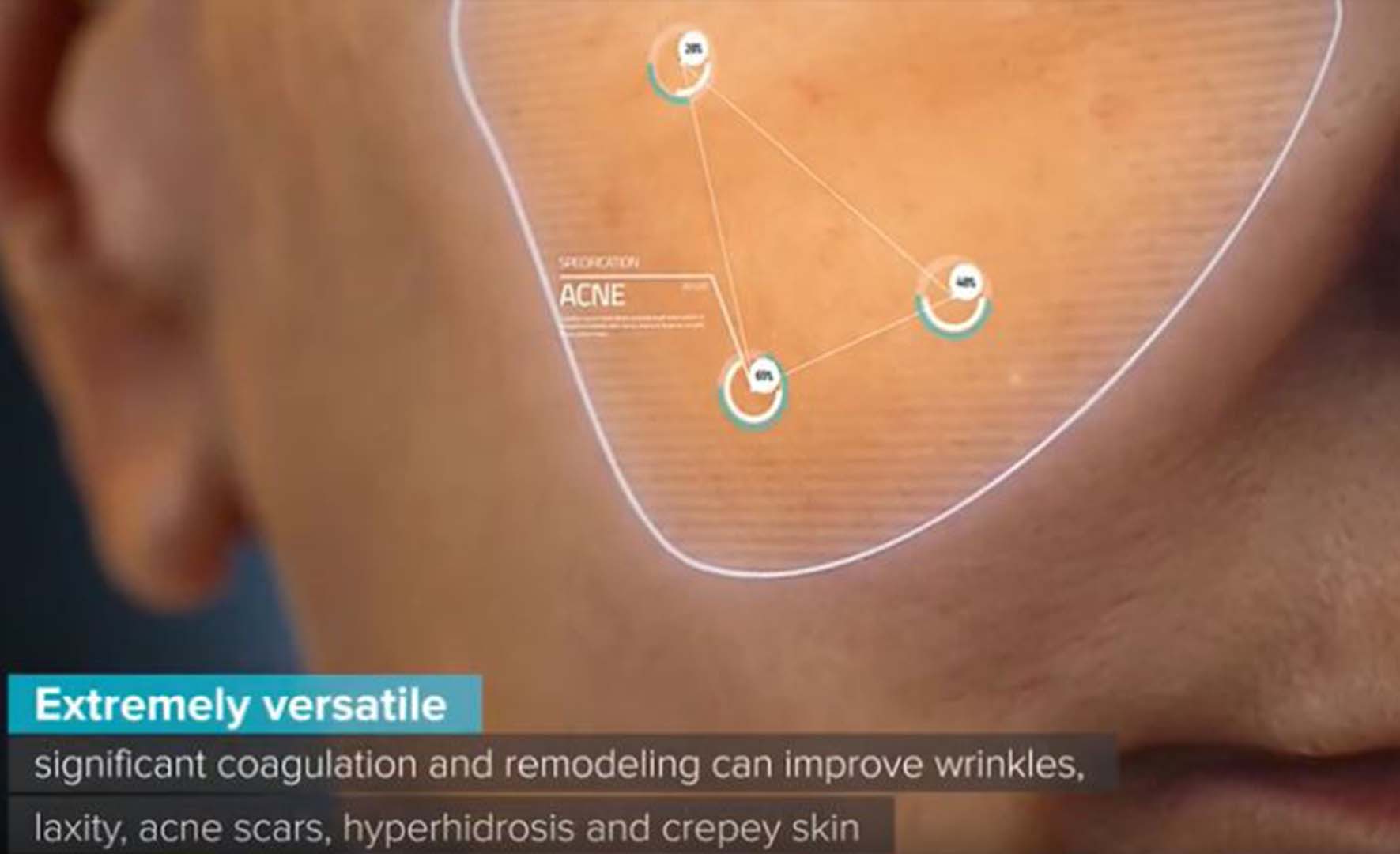 lutronic rf genius microneedling display of acne scarring