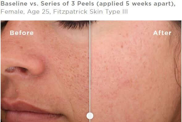 Peel allergan 1