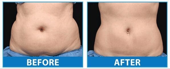 coolsculpting-mature woman, torso