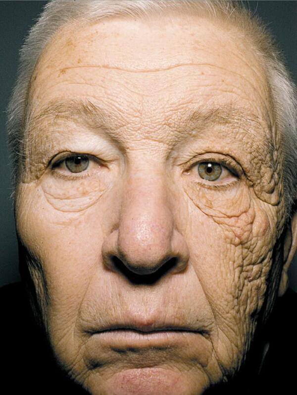 truck-driver-sun-damage