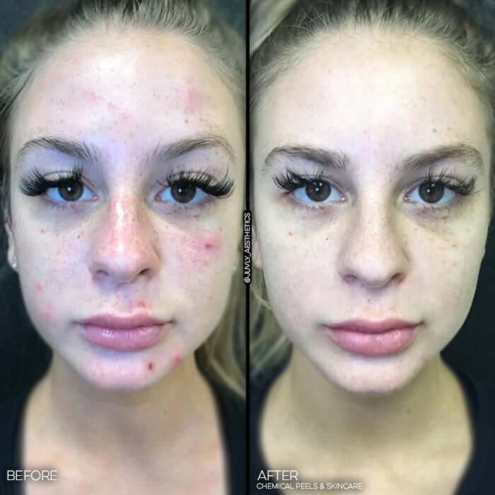 10112018 Deep cleansing facial with major extractions, Microdermabrasion, Chemical Peels, Lactic Acid Clenziderm Acne Kit, Obagi Tret .025 skinbetter alto Kylene Globis 003b (1) 10112018 Deep cleansing facial with major extractions, Microdermabrasion, Chemical Peels, Lactic Acid Clenziderm Acne Kit, Obagi Tret .025 skinbetter alto Kylene Globis 003b (1)