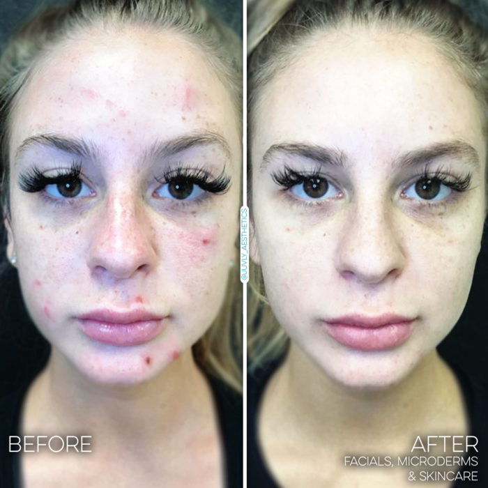 Facial Microderm Skincare 002 Facial Microderm Skincare 002