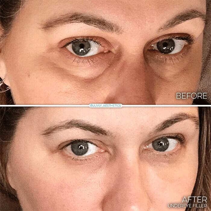 causes-of-undereye-bags-filler