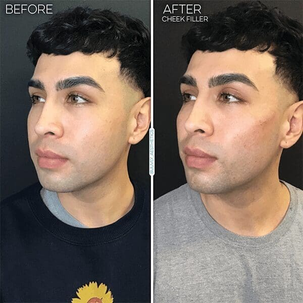 cheek-filler-man