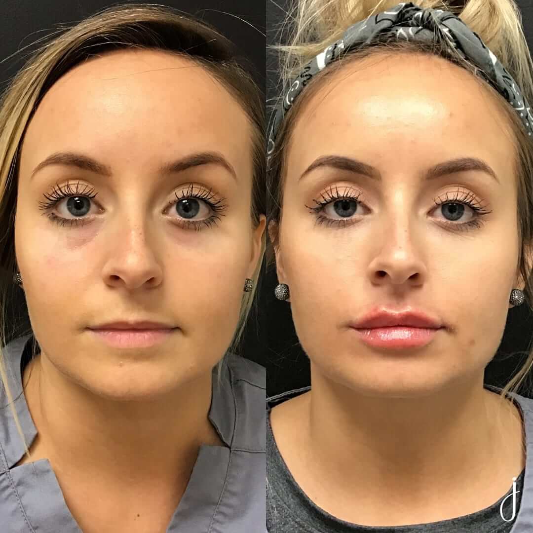BNA4 Hannah Cole under eyes 1 Restylane-L chalie lips 1 versa 120619
