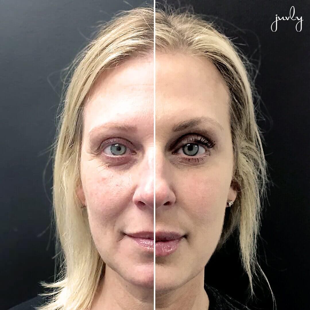 Christi Poe BNA full botox defyne lip copy