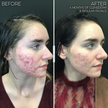 Kelsey Clenziderm Facials 002