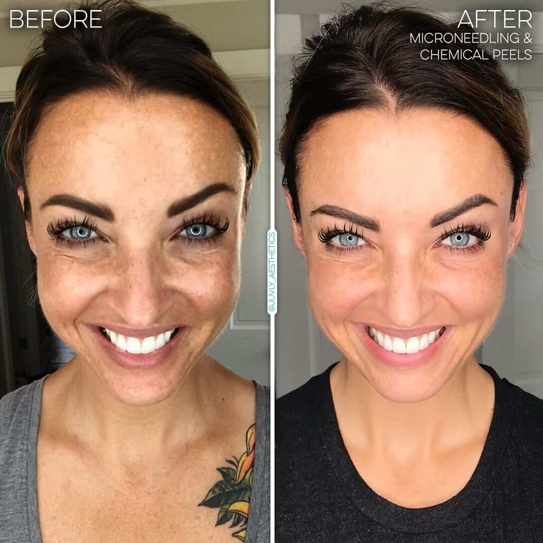 Microneedling Chemical Peels 001